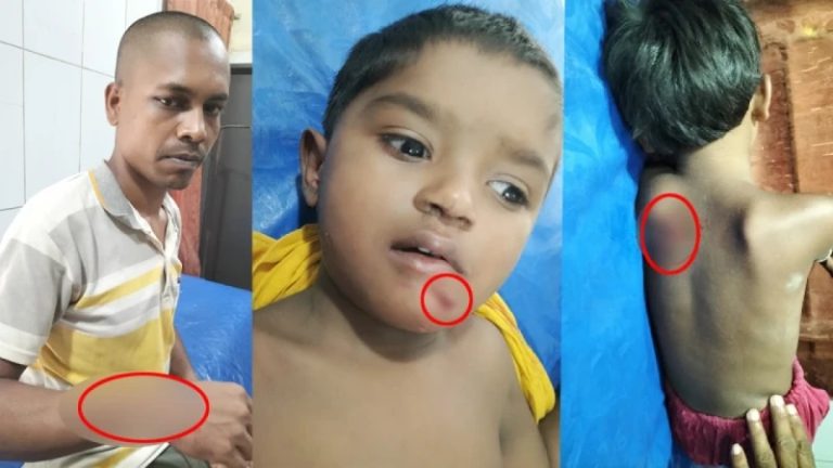 ভূঞাপুরে পাগলা কুকুরের কামড়ে নারী ও শিশুসহ ২২ জন আহত