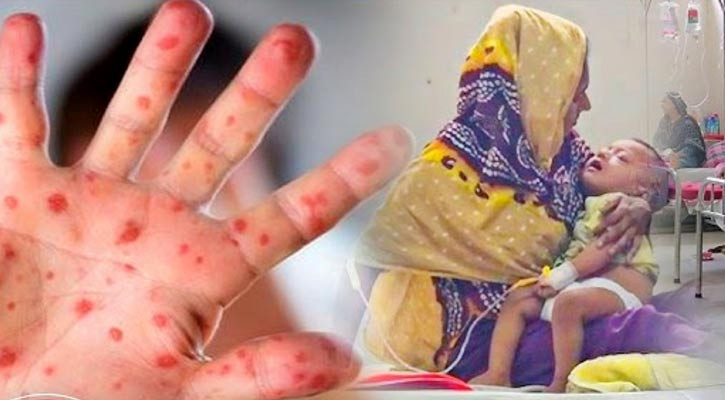 টাংগাইলে হামের উপসর্গ নিয়ে এক শিশুর মৃত্যু